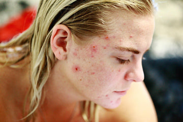 Causas principales del acné
